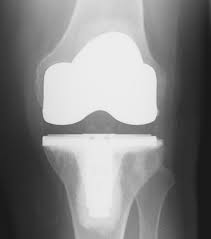 knee arthritis, knee DJD , osteoarthritis, arthritis, knee surgery, knee joint replacement